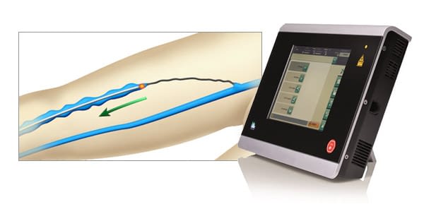 レーザー静脈瘤手術：それについてすべてを知る